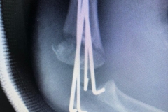 Suprakondiler humerus kırığı çocuklarda en sık gördüğümüz kırıklardan