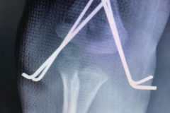 Suprakondiler humerus kırığı çocuklarda en sık gördüğümüz kırıklardan